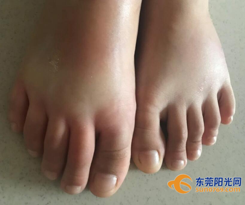 有孩子被咬了红火蚁毒性强户外游玩需留意